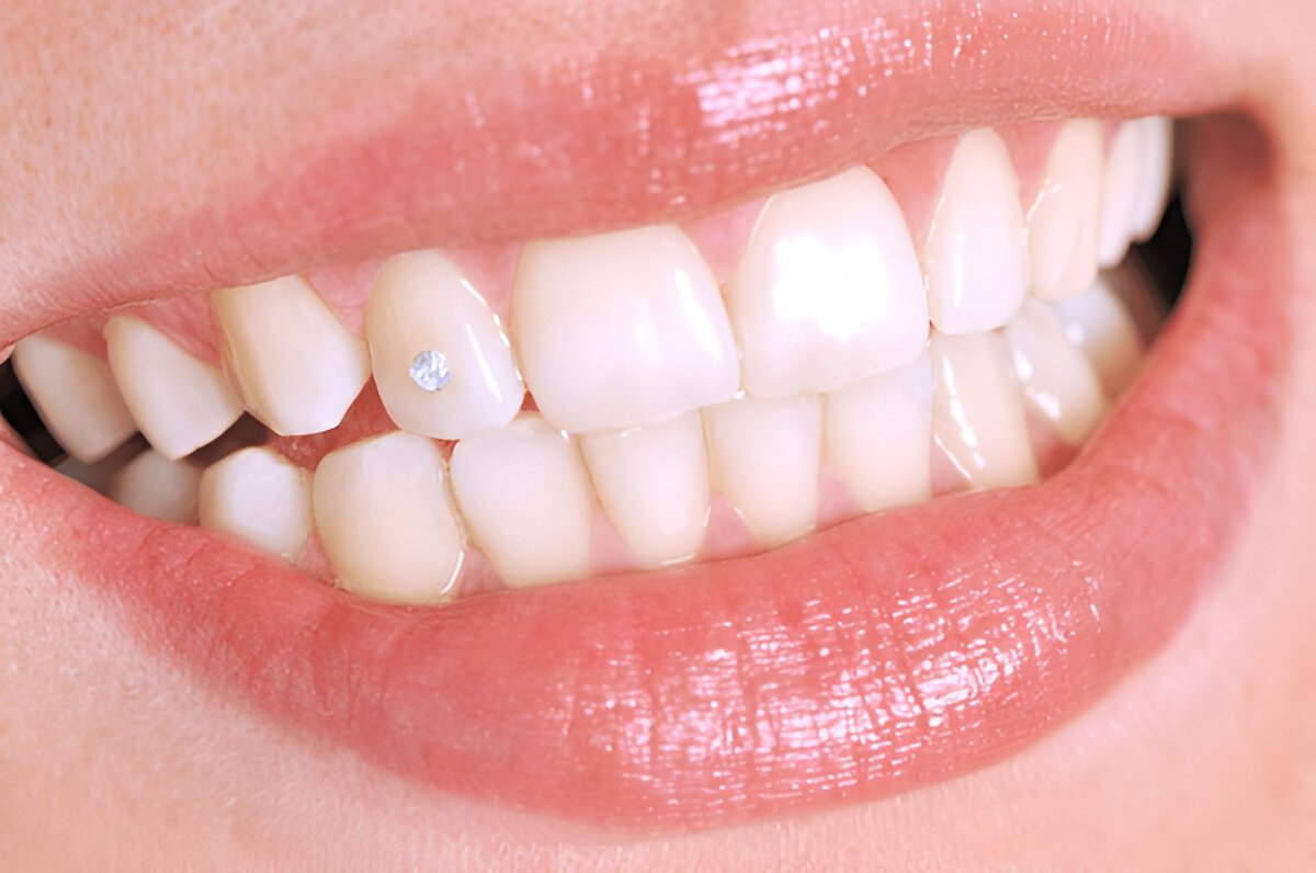 Tooth Gems