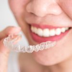 clear aligners with teeth whitening