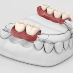 3d illustration of human teeth with a dental bridge