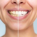 what causes sudden discoloration of teeth
