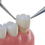 how to keep your zirconia teeth white